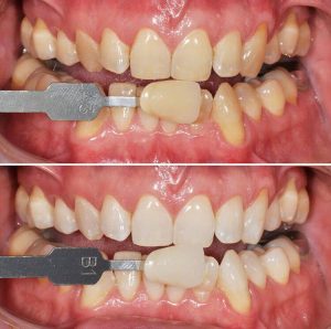 shovel provoke stitch Albirea dintilor - Albire dentara - Clinicile DentoCare