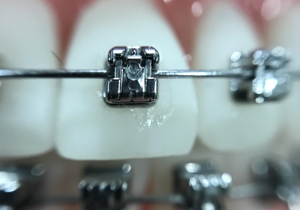 aparat dentar metalic fix