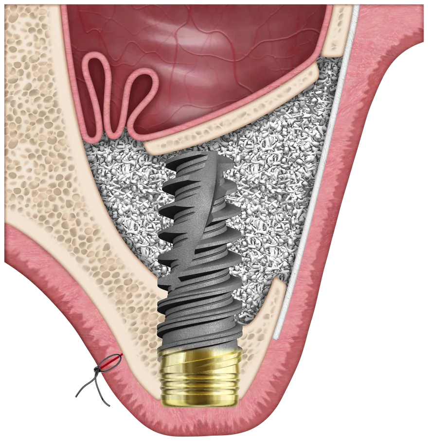 Ilustrație: implant dentar înconjurat de material pentru adiție osoasă, în maxilarul superior, sub sinusul maxilar