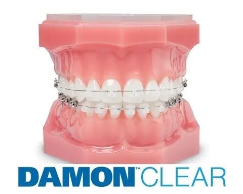 Machetă dentară cu aparat autoligaturant Damon Clear și sigla Damon Clear