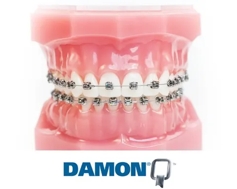 Machetă dentară cu aparat autoligaturant Damon Q și sigla Damon Q