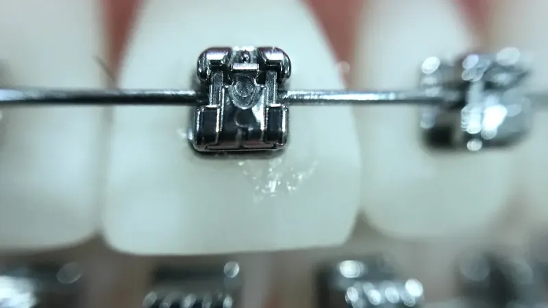 Cum poți corecta alinierea dinților cu un aparat dentar