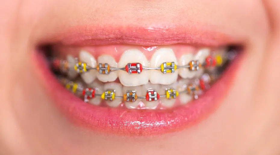 Zâmbet cu aparat dentar metalic și elastice colorate