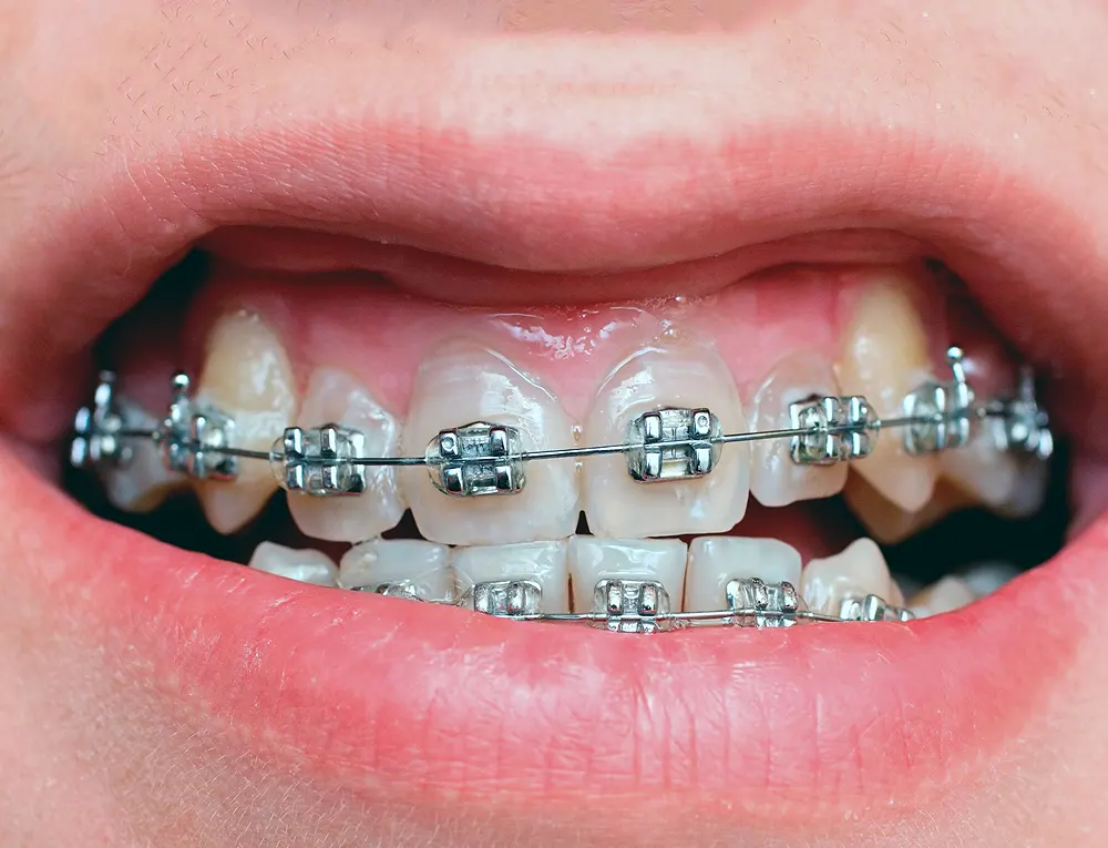 Aparat dentar metalic fix pe dinți înghesuiți, cu brackeți și arc ortodontic