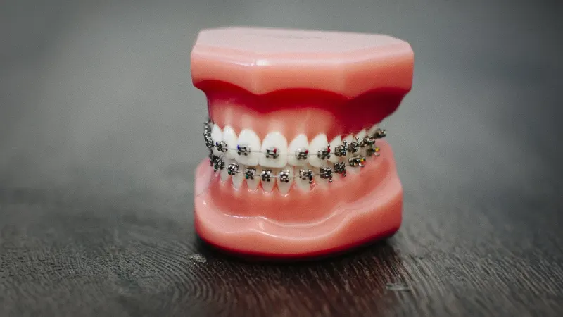 Aparatele dentare: ce sunt, beneficii, tipuri și costuri