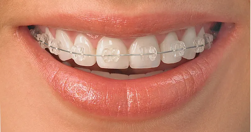 Zâmbet cu aparat dentar fix cu brackeți estetici, transparenți