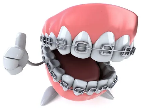Machetă dentară cu aparat dentar fix cu brackeți metalici