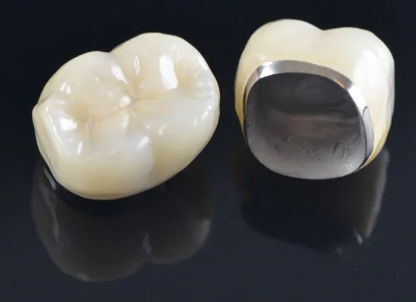 Două coroane metalo-ceramice: una văzută de sus, cu suprafața de ceramică, cealaltă din interior, cu capa metalică