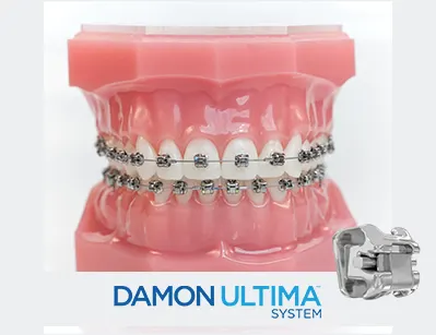 Machetă dentară cu aparat autoligaturant Damon Ultima™ și sigla Damon Ultima System