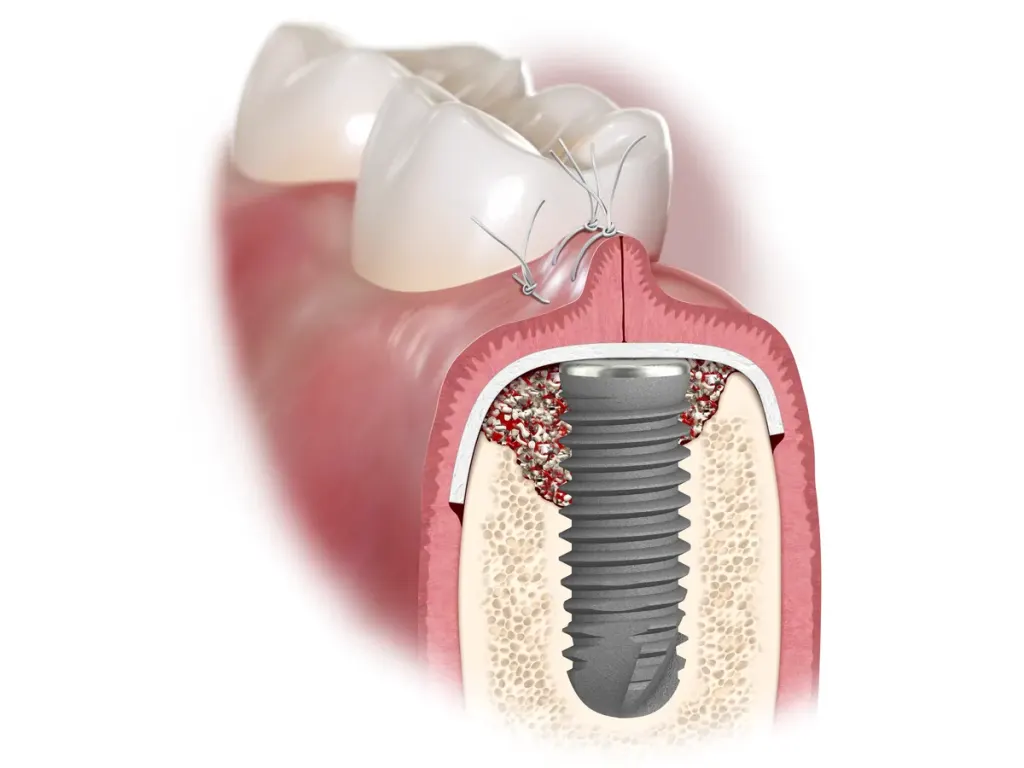 Ilustrație 3D în secțiune: implant dentar cu defect osos în jur, tratat cu adiție osoasă și membrană